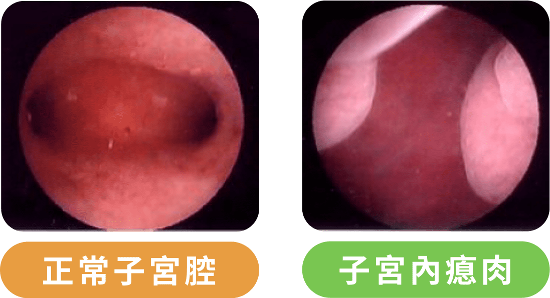 子宮腔鏡檢查